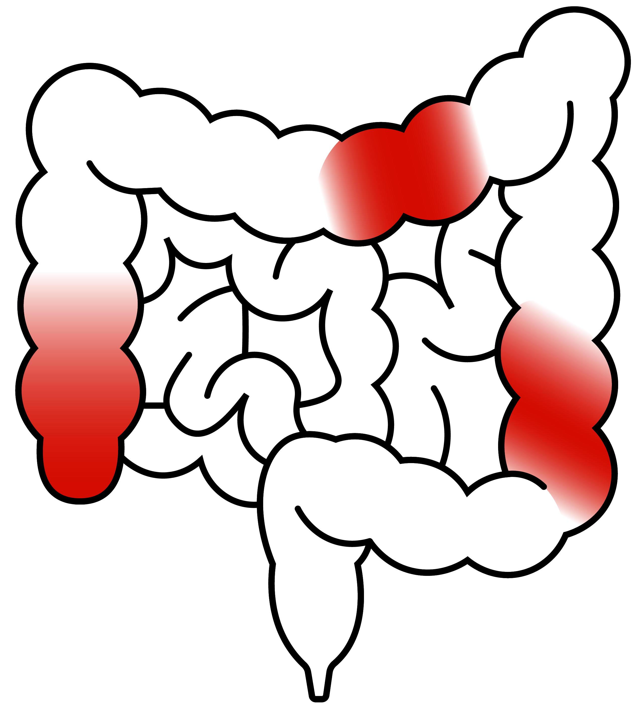 Inflammation of the gut (Crohn's disease)