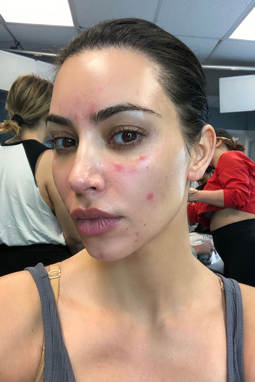 Kim Kardashian - psoriasis