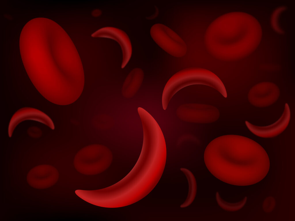 Red blood cells of sickle cell anemia disease.