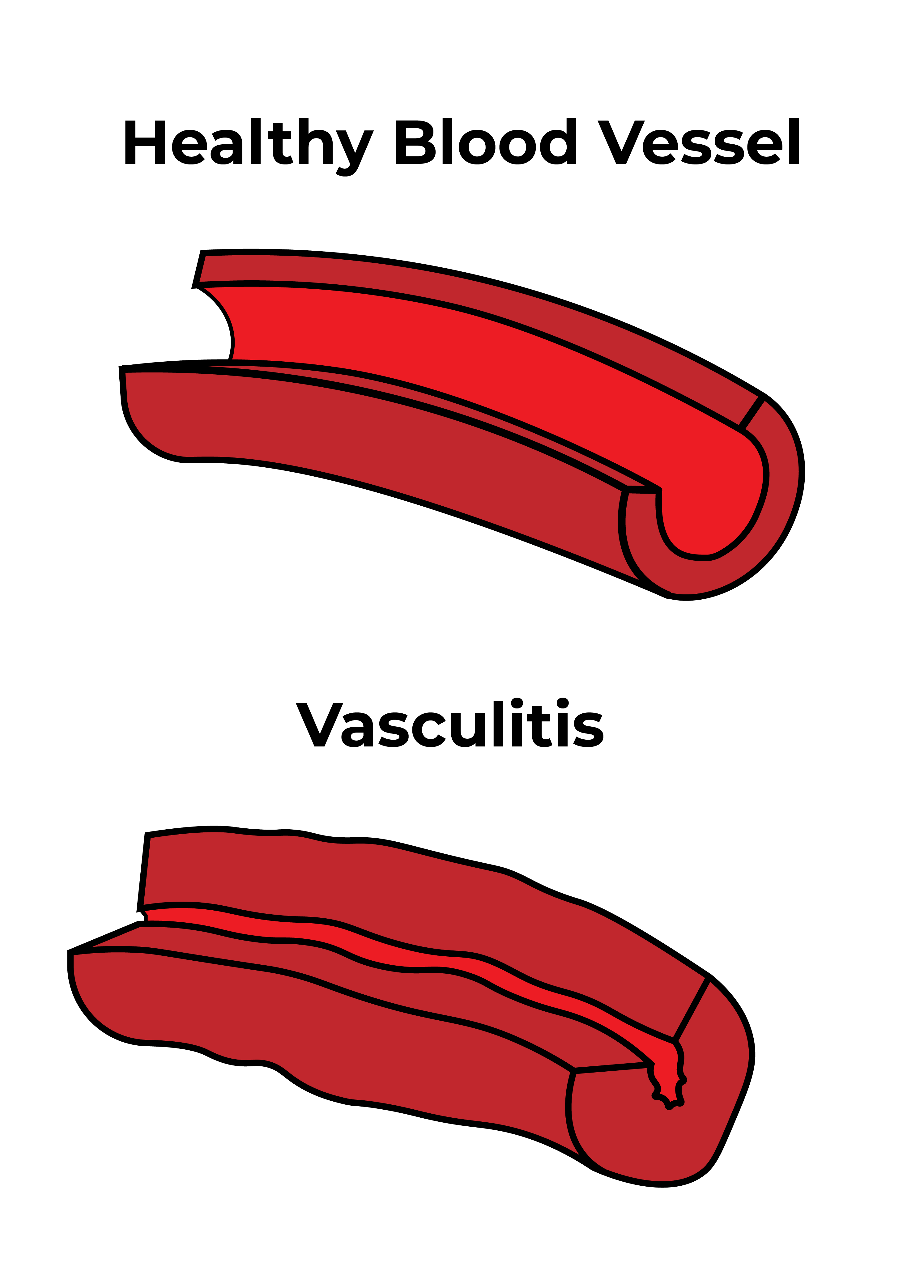 Healthy blood vessel versus vasculitis